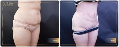 Before and after 360 liposuction results at Asia Cosmetic Hospital, improved body contour