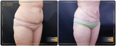 Before and after 360 liposuction results at Asia Cosmetic Hospital, visible body contouring