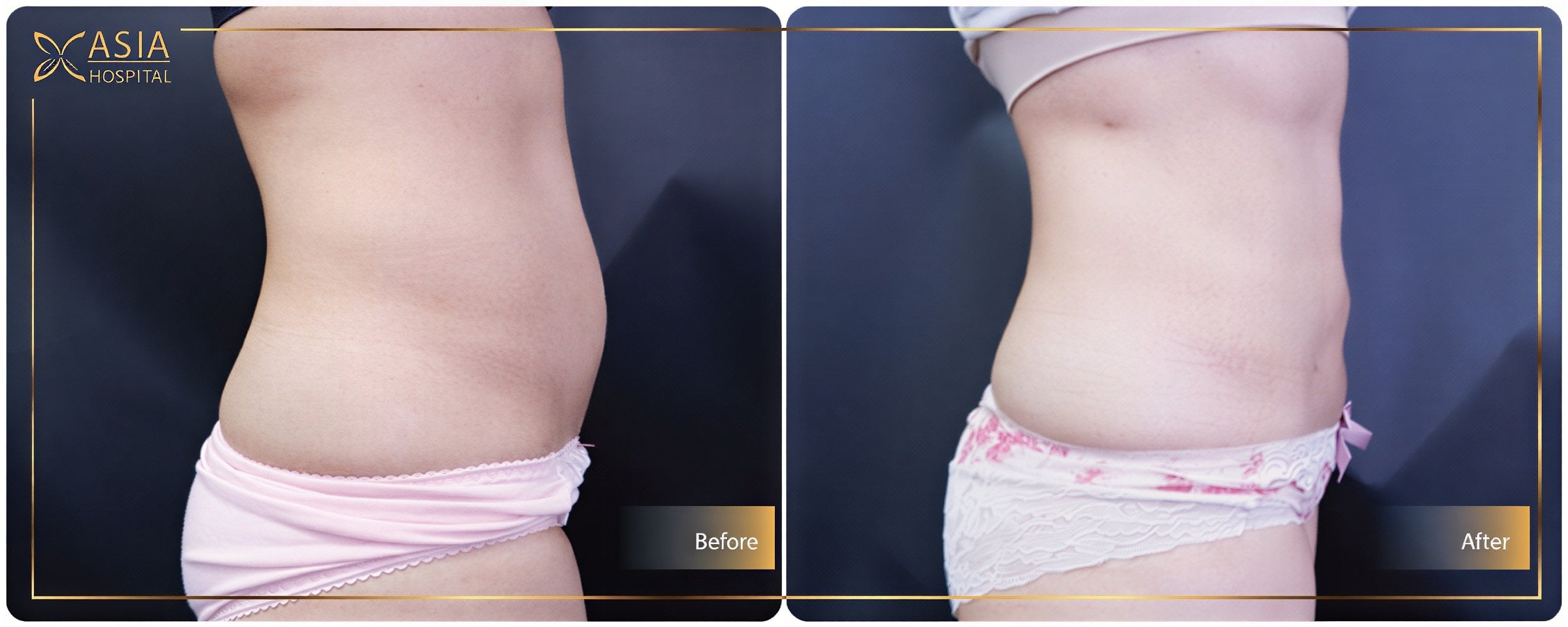 Resultados de liposucción 360 antes y después en Asia Cosmetic Hospital, contorno mejorado