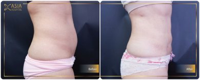 Before and after 360 liposuction results at Asia Cosmetic Hospital, improved body contour