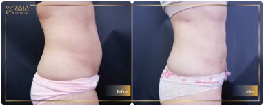Before and after 360 liposuction results at Asia Cosmetic Hospital, improved body contour