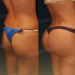 Vorher-nachher-Ergebnis Brazilian Butt Lift bei Memorial Bahçelievler Hospital, verbesserte Kontur