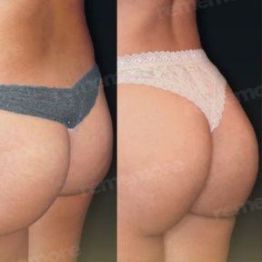 Vorher-nachher-Ergebnis Brazilian Butt Lift im Memorial Bahçelievler Hospital