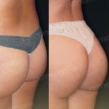 Vorher-nachher-Ergebnis Brazilian Butt Lift im Memorial Bahçelievler Hospital