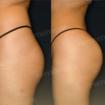 Vorher-nachher-Ergebnis Brazilian Butt Lift bei Memorial Bahçelievler Hospital, verbesserte Kontur