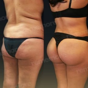 Vorher-nachher-Ergebnis Brazilian Butt Lift bei Memorial Bahçelievler Hospital, Körperkontur