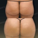 Vorher-nachher-Ergebnis Brazilian Butt Lift bei Memorial Bahçelievler Hospital, verbesserte Form