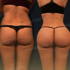 Vorher-nachher-Ergebnis Brazilian Butt Lift bei Memorial Bahçelievler Hospital, verbesserte Kontur