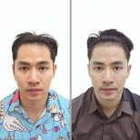 نتائج زراعة الشعر قبل وبعد في عيادة Dr.Nutt، خط شعر وكثافة محسّنة