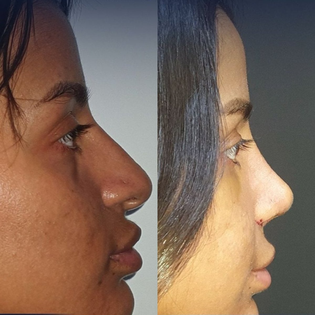 نتائج قبل وبعد تجميل الأنف العرقي في عيادة Dr. Safa Manav، إعادة تشكيل الأنف