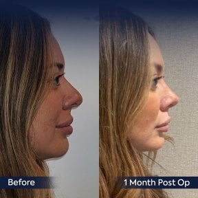 Vorher-nachher-Rhinoplastik-Ergebnis bei Dr. Safa Manav Clinic, verbesserte Nasenform