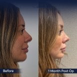 Vorher-nachher-Rhinoplastik-Ergebnis bei Dr. Safa Manav Clinic, verbesserte Nasenform