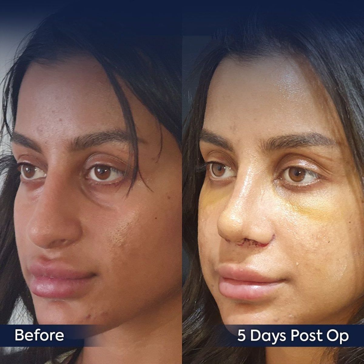 Rinoplastia étnica antes y después en Dr. Safa Manav Clinic, remodelación visible de la nariz