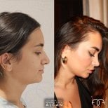 Vorher-nachher-Rhinoplastik-Ergebnisse in der Dr. Safa Manav Clinic, verbesserte Nasenprofil