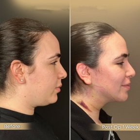 Vorher-nachher-Ergebnis Halsstraffung bei Dr. Safa Manav Clinic, verbesserte Kieferlinie