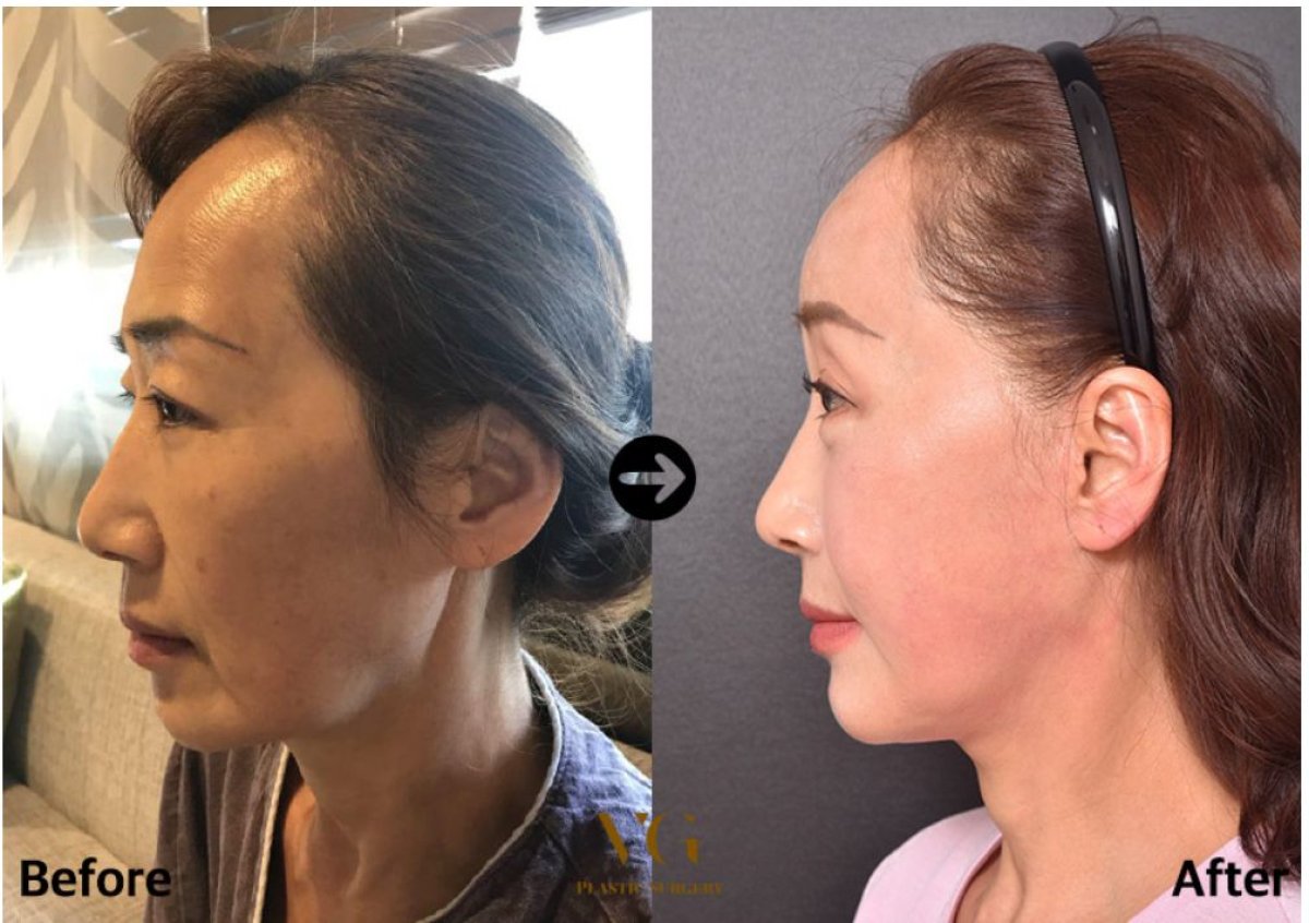 Resultados de transferencia de grasa facial antes y después en VG Plastic Surgery, mayor volumen