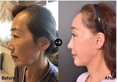 Vorher-nachher-Ergebnis der Gesichtsfetttransplantation bei VG Plastic Surgery, mehr Volumen