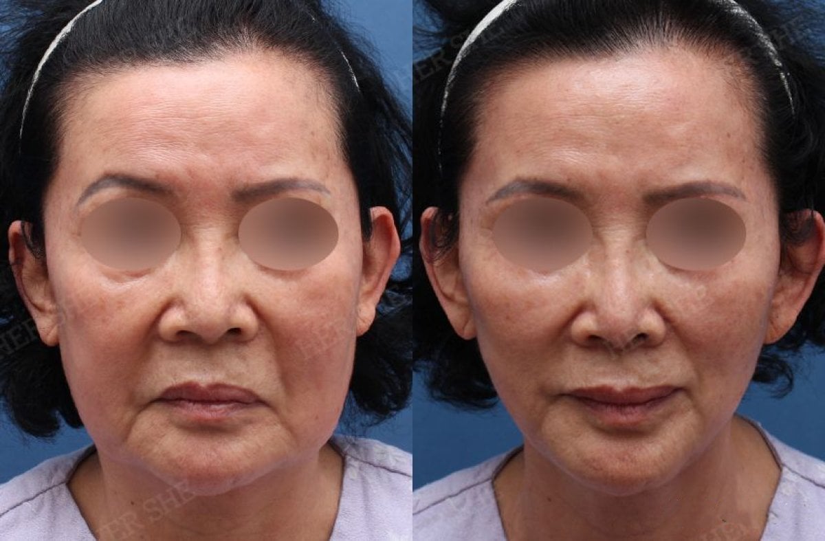 نتائج قبل وبعد نقل الدهون للوجه في HERSHE Plastic Surgery Korea، تجديد البشرة