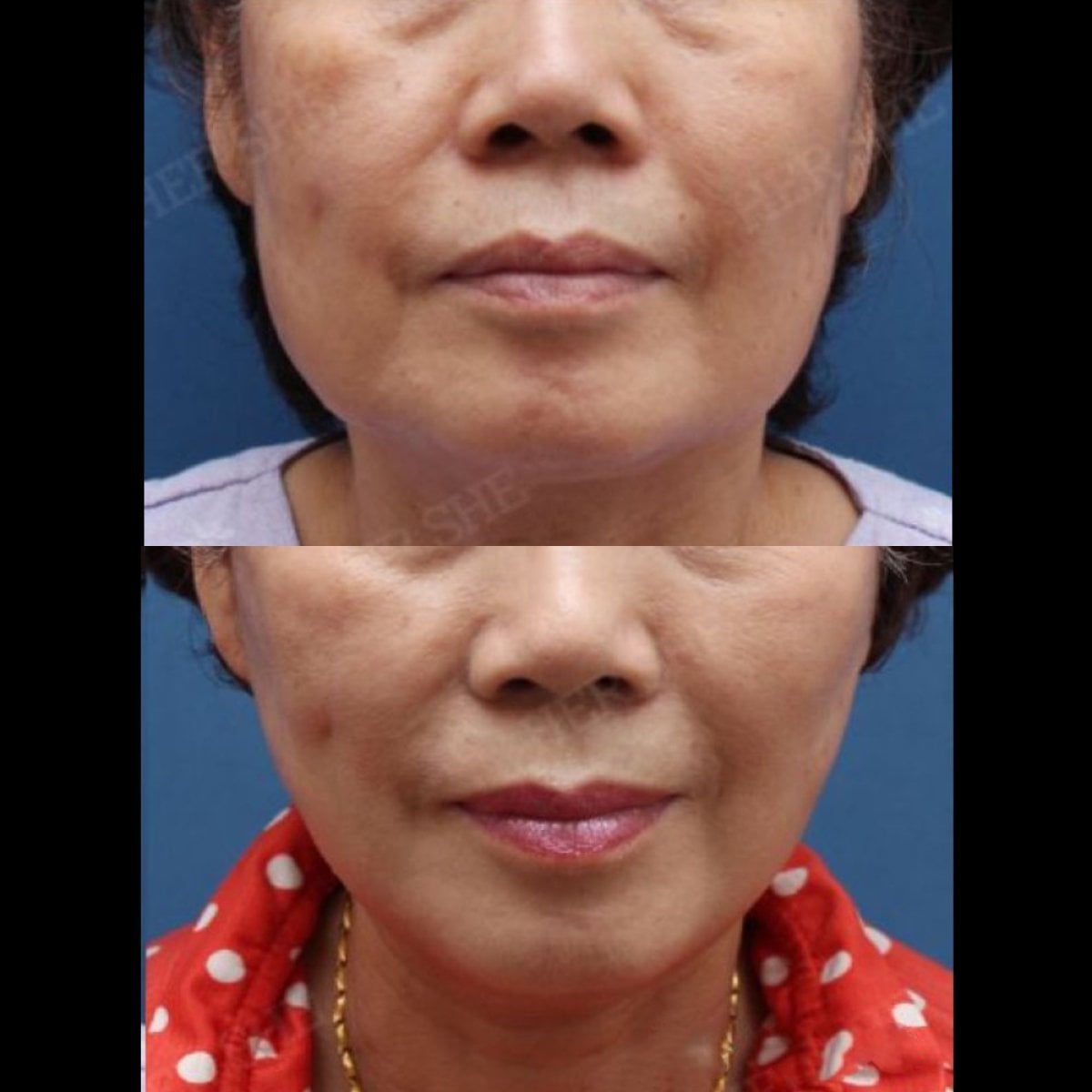 نتائج نقل دهون الوجه قبل وبعد في HERSHE Plastic Surgery Korea، خدود أكثر شبابًا