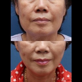 Résultats avant/après lipofilling visage chez HERSHE Plastic Surgery Korea, joues rajeunies
