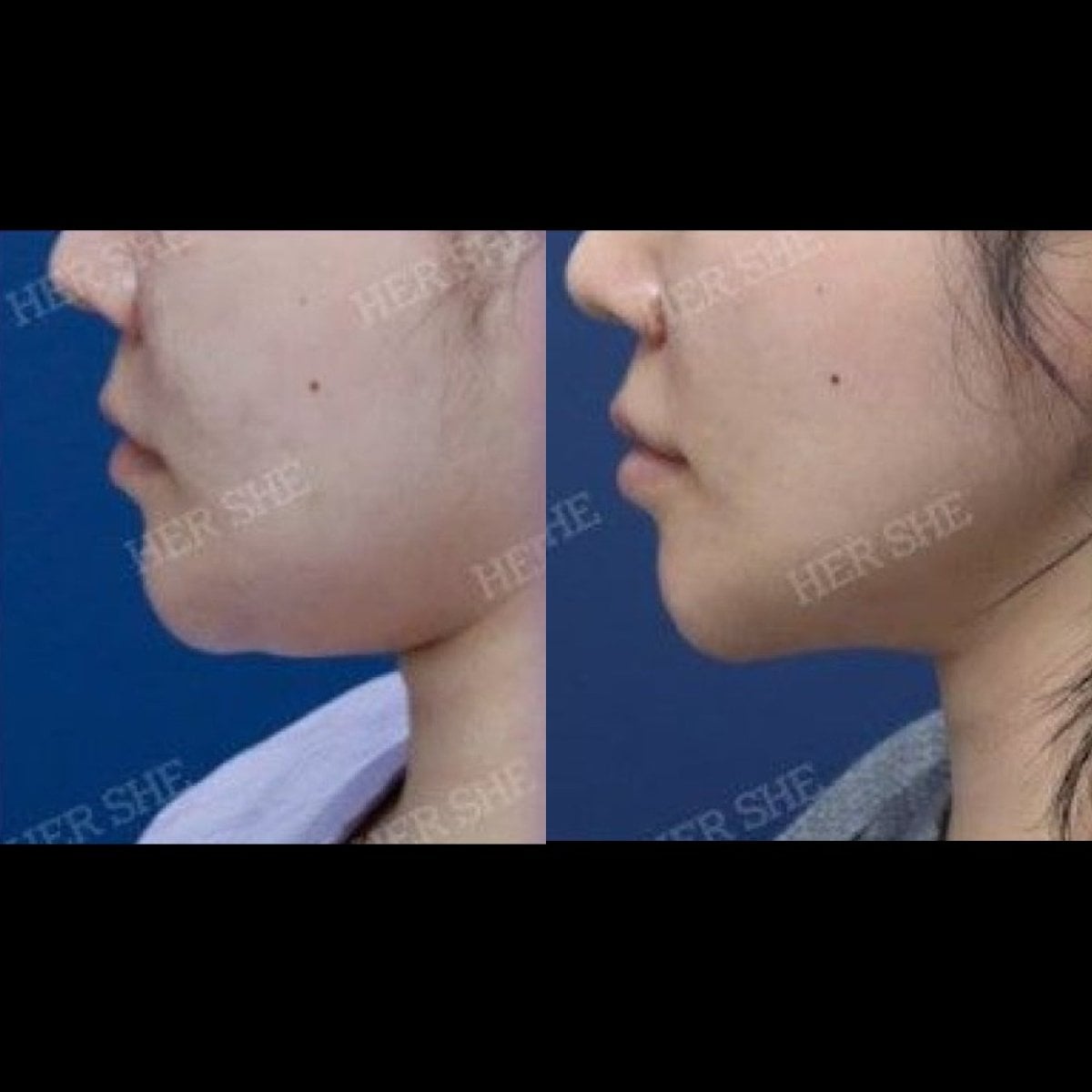 نتائج نقل دهون الوجه قبل وبعد في HERSHE Plastic Surgery Korea، تحسين تحديد الوجه