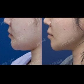 Résultats avant/après lipofilling visage chez HERSHE Plastic Surgery Korea, contour amélioré