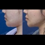 Résultats avant/après lipofilling visage chez HERSHE Plastic Surgery Korea, contour amélioré