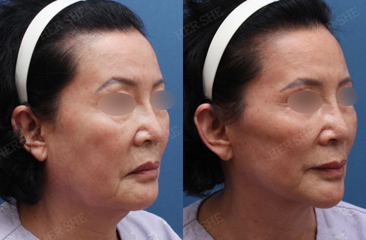 Resultados antes y después de deep plane facelift en HERSHE Plastic Surgery Korea, rejuvenecimiento facial