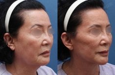 Before and after deep plane facelift results at HERSHE Plastic Surgery Korea, facial rejuvenation