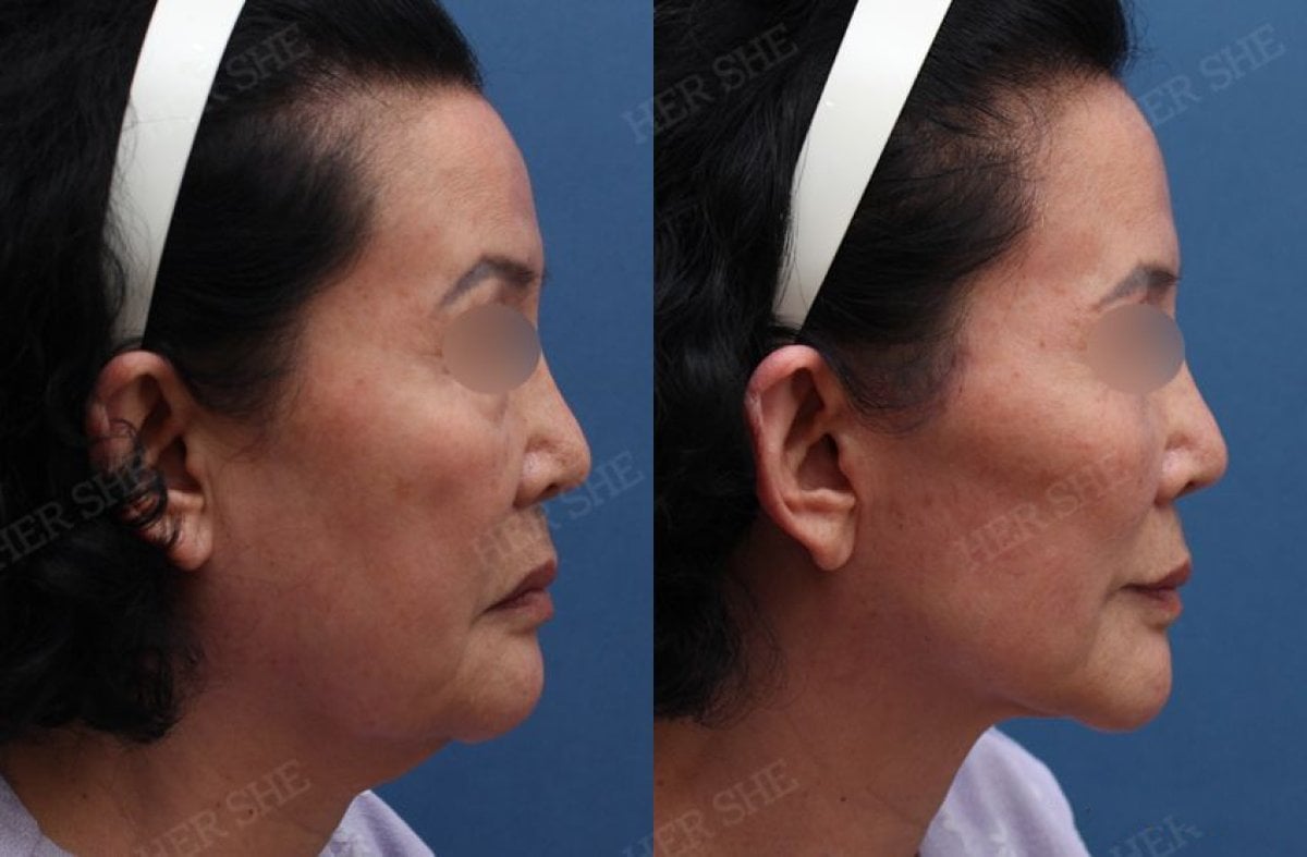 نتائج شد الوجه العميق قبل وبعد في HERSHE Plastic Surgery Korea، تجديد شباب الوجه