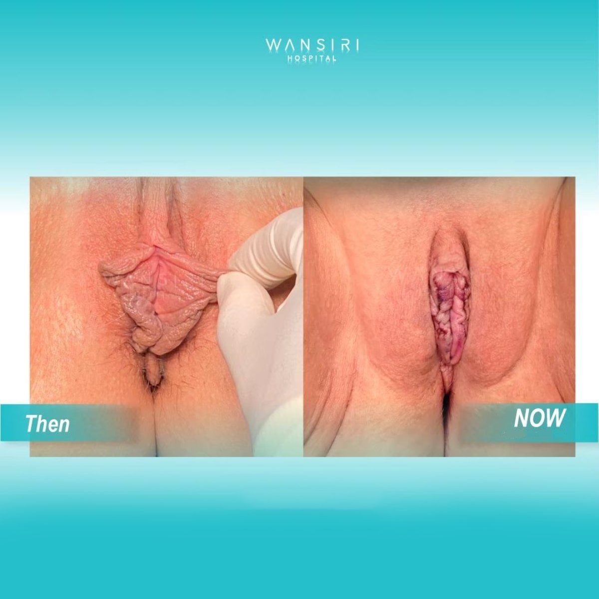 Resultados antes y después de labioplastia en Wansiri Hospital, mejora del aspecto de los labios