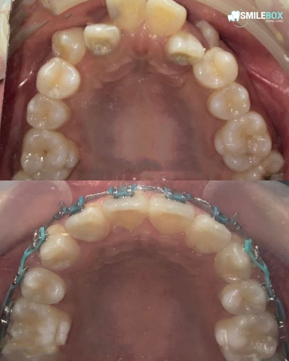 نتيجة تقويم الأسنان للكبار قبل وبعد في SmileBox Dental Clinic - Thonglor، تحسين اصطفاف الأسنان