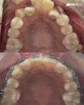 Before and after adult braces result at SmileBox Dental Clinic - Thonglor, teeth alignment improved