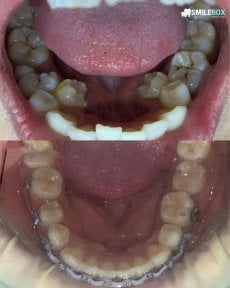 Before and after adult braces results at SmileBox Dental Clinic - Thonglor, improved alignment