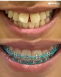 Before and after adult braces result at SmileBox Dental Clinic - Thonglor, improved teeth alignment