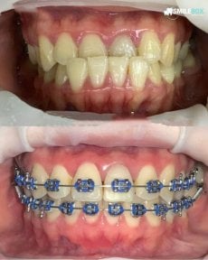 Before and after adult braces results at SmileBox Dental Clinic - Thonglor, Sukhumvit Branch