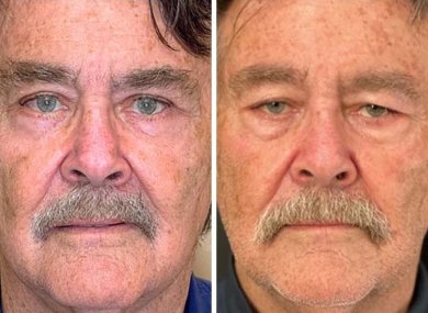 Resultados de blefaroplastia antes y después en Italian Eye Hospital, corrección de párpados