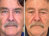 Resultados de blefaroplastia antes y después en Italian Eye Hospital, corrección de párpados