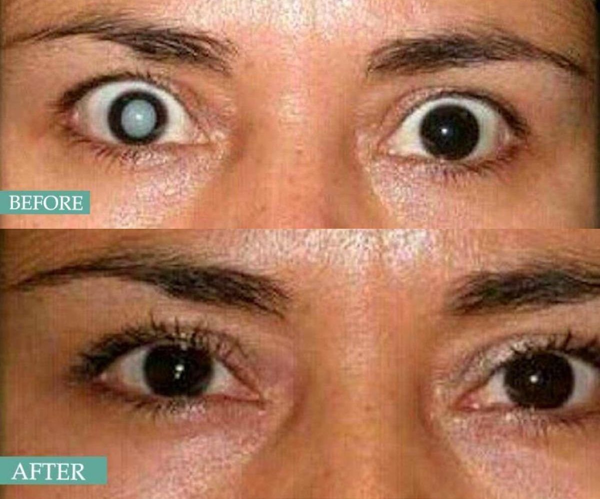 Resultado antes y después de cirugía de cataratas con lente multifocal en Italian Eye Hospital