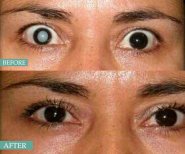 Vorher-nachher-Ergebnis der Kataraktoperation mit Multifokallinse in Italian Eye Hospital