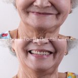 Before and after denture results at About Tooth Dental Clinic – improved smile restoration