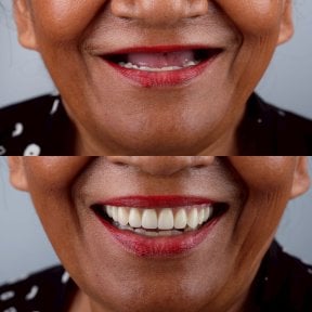 Результаты до и после протезирования в About Tooth Dental Clinic – восстановленная улыбка