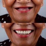 Результаты до и после протезирования в About Tooth Dental Clinic – восстановленная улыбка