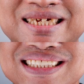 Результаты до и после протезирования в About Tooth Dental Clinic – улучшенная улыбка