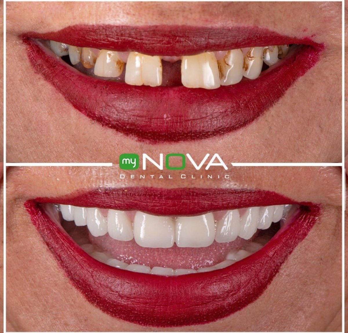 Resultado antes y después de implantes All-on-6 en My Nova Kusadasi Dental Clinic, cambio de sonrisa