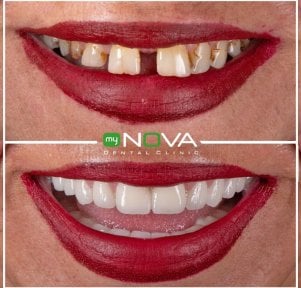 Before and after All-on-6 dental implants result at My Nova Kusadasi Dental Clinic, smile makeover
