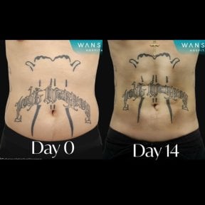Before and after Vaser liposuction results at Wansiri Hospital, visible abdominal contouring