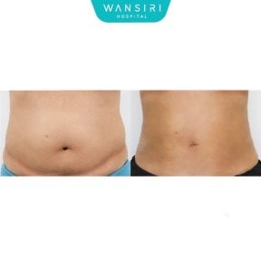 Before and after Vaser liposuction results at Wansiri Hospital, abdomen contour improvement