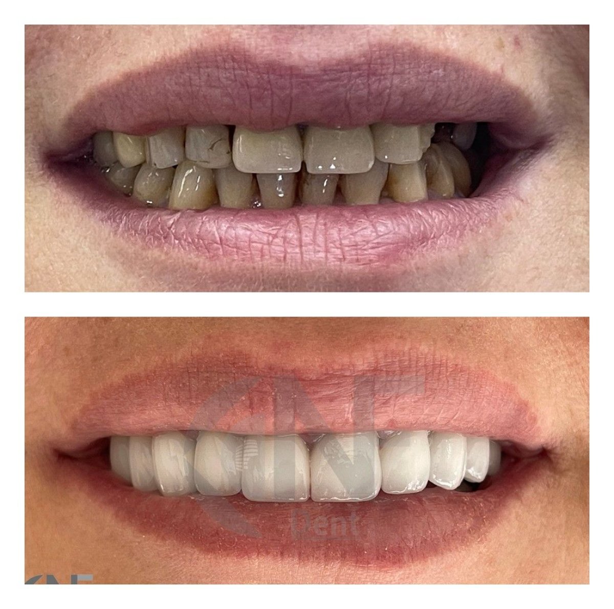Antes y después del tratamiento dental con sedación en Nifa Dent International, resultado de sonrisa