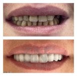 Before and after dental treatment with sedation at Nifa Dent International, smile makeover result